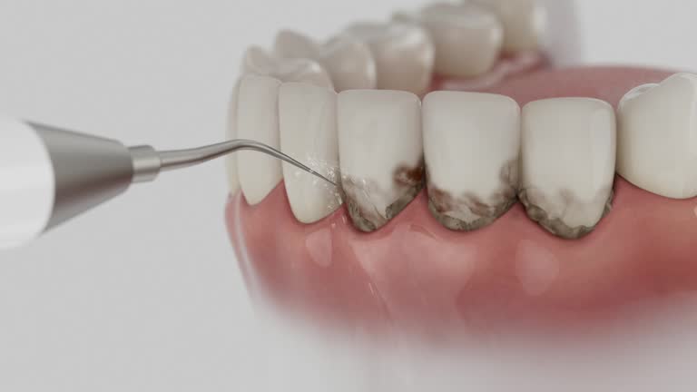 Trusted Wisdom Tooth Removal service in Dallas, GA - Dentist Open Now